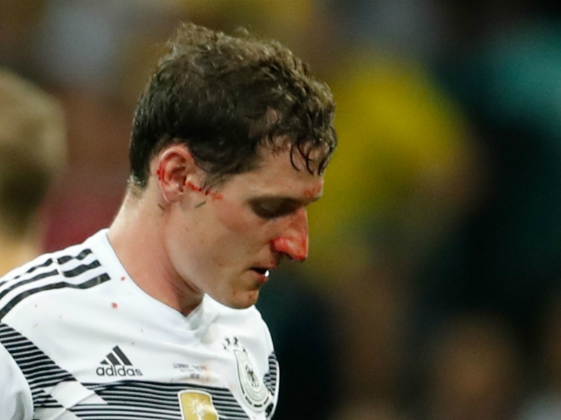 Possible broken nose leaves Germany's Rudy in doubt for South Korea clash